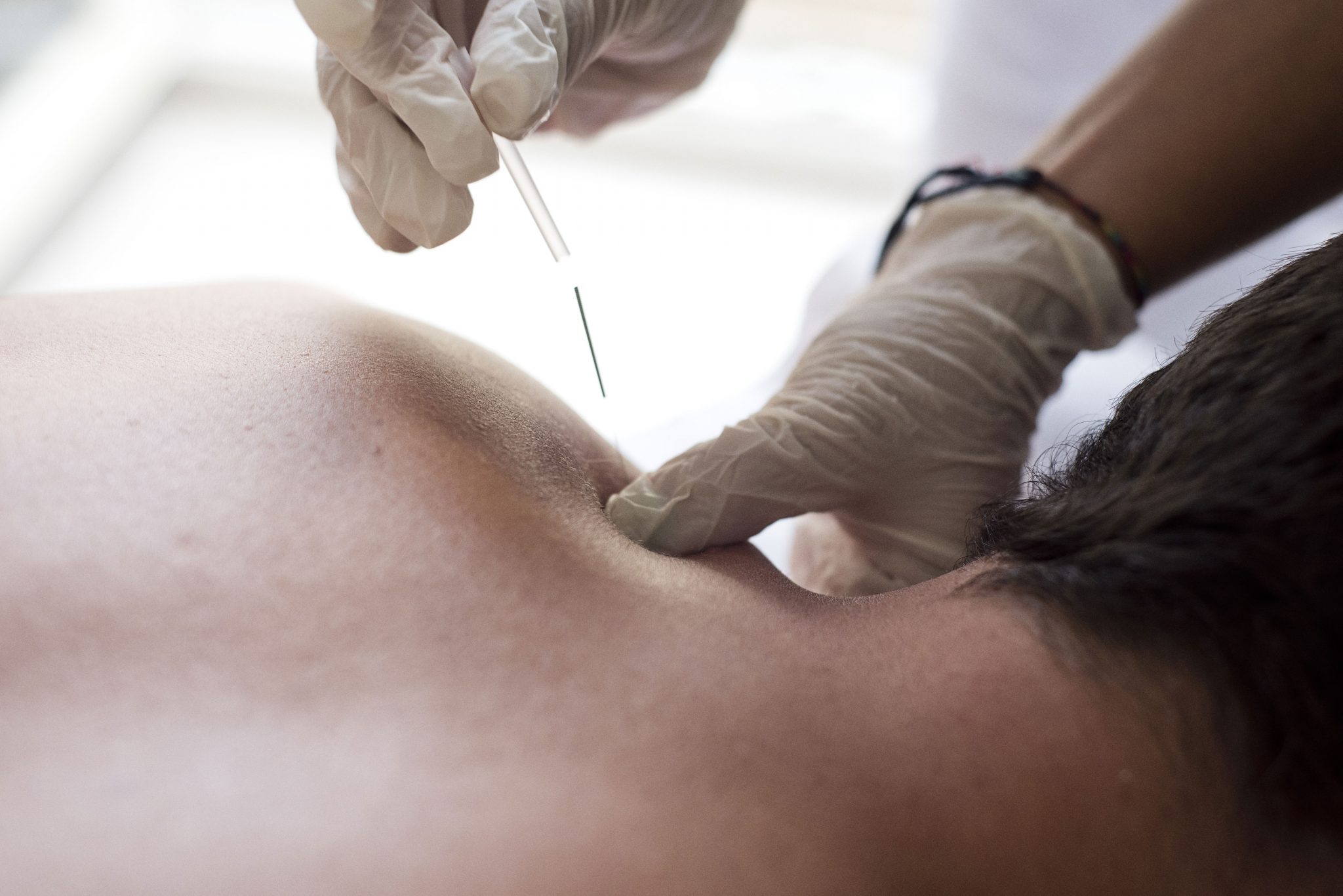 ¿Qué es la punción seca y cómo puede aliviar el dolor muscular?