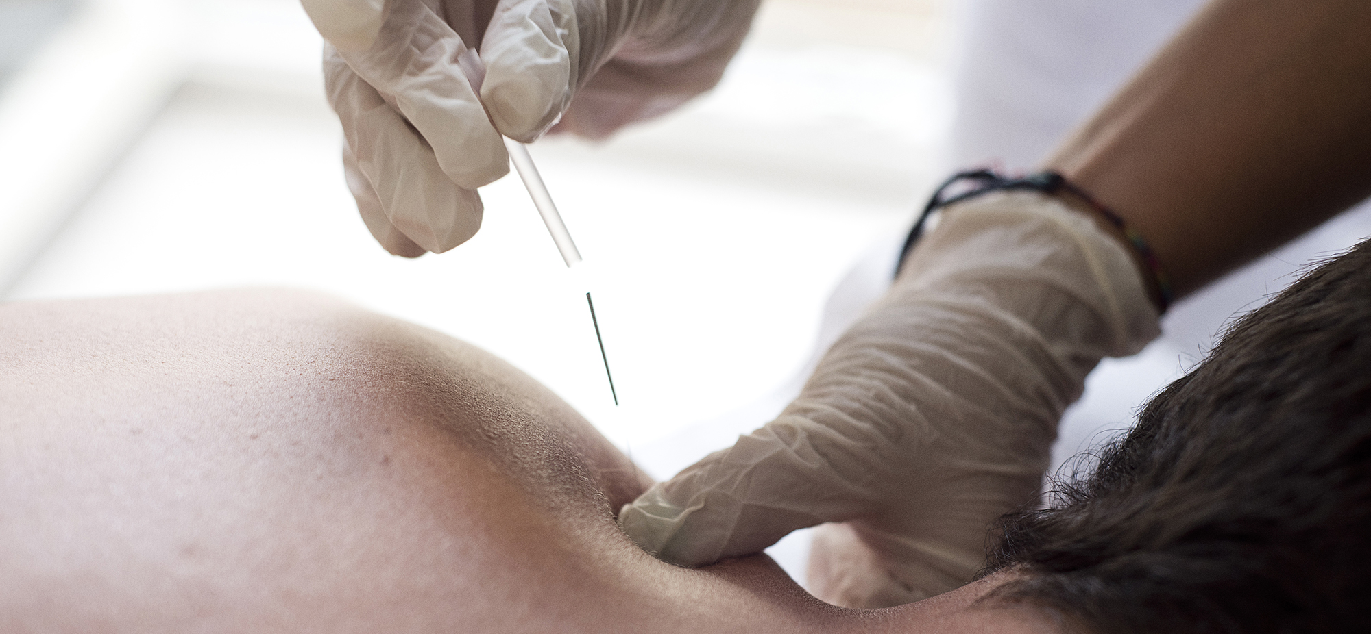 Fisioterapia. Punción seca